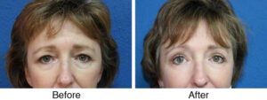 A before and after picture of an older woman 's eyes.