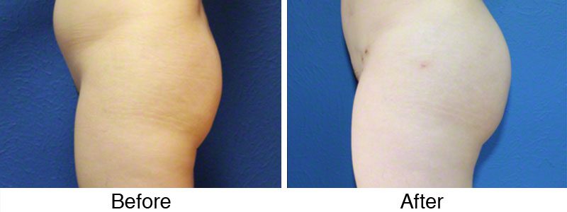 A before and after photo of the same patient 's buttocks.