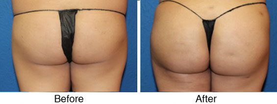 A before and after photo of a woman 's buttocks.