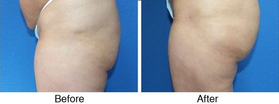A before and after picture of the same patient 's buttocks.