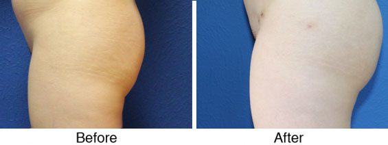 A before and after picture of the same patient 's arms.