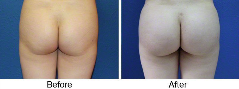A before and after photo of the back of a woman 's buttocks.