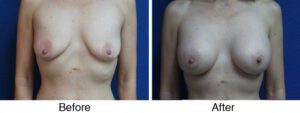 A before and after photo of a woman with breast implants.