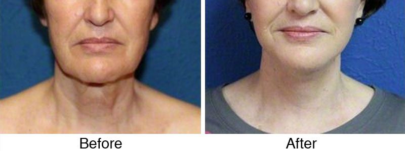 A before and after photo of a woman 's neck.