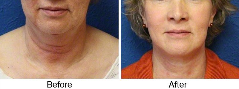 A woman with a facelift and neck lift