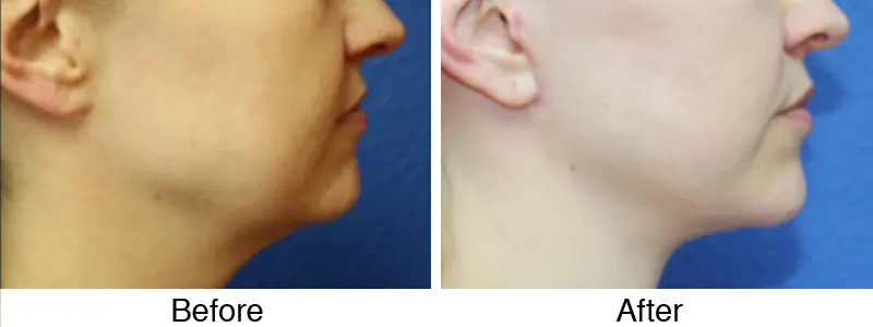 A woman 's face and ear before and after surgery.