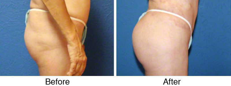 A before and after picture of a woman 's butt.