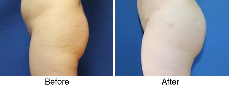 A before and after picture of the same patient 's buttocks.
