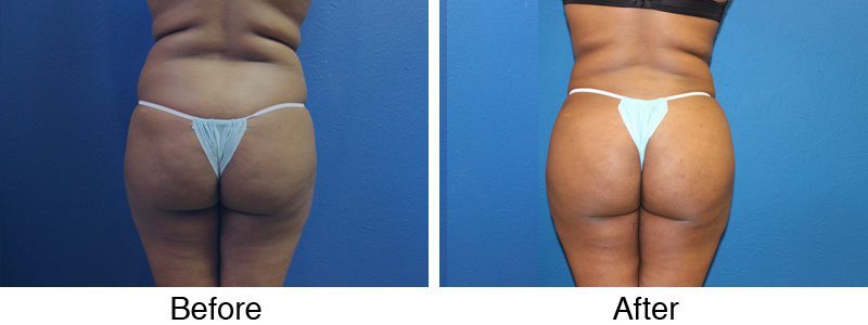 A before and after picture of a woman 's buttocks.