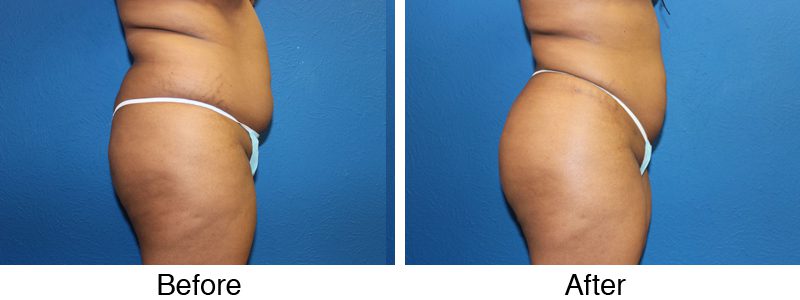 A woman 's buttocks and hips before and after surgery.