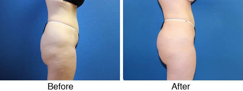 A before and after picture of a woman 's buttocks.