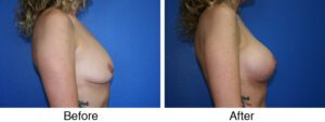 A woman with breast implants and an underarm view.