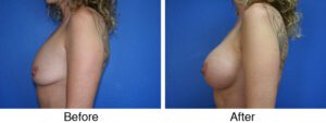 A before and after picture of breast augmentation surgery.