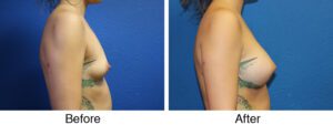 A woman with breast augmentation and liposuction.