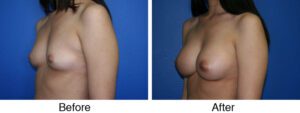 A woman with breast implants before and after surgery.