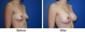 A woman with breast implants and surgery on her breasts.