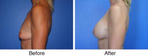 A before and after photo of a woman 's breast augmentation.