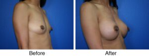 A before and after photo of a woman 's breast.