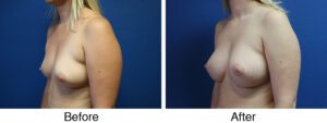 A before and after photo of a woman 's breast