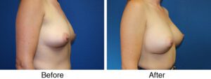 A before and after photo of a woman 's breast augmentation.