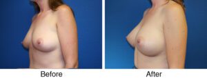 A before and after photo of a woman 's breast.