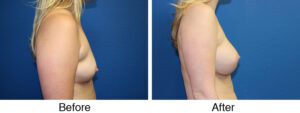 A woman with a breast augmentation and liposuction.