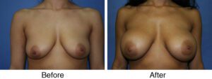 A woman with large breast has her breasts exposed.