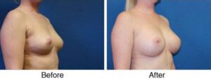 A woman with breast augmentation surgery on her arms.