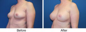 A woman with breast implants and without surgery.