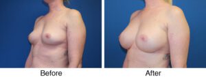 A woman with breast implants and without surgery.