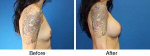 A woman with tattoos is shown before and after surgery.