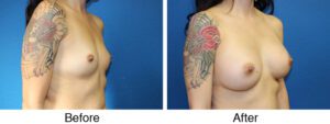 A woman with breast implants and tattoos.
