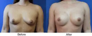 A before and after picture of a woman with breast implants.