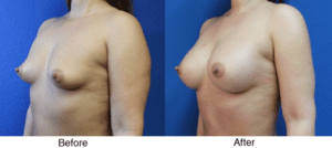 A woman with breast implants before and after surgery.