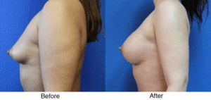 A before and after picture of a woman 's breast.