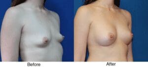 A before and after picture of breast augmentation surgery.