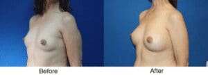 A before and after photo of a woman 's breast.