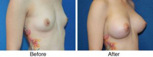 A before and after photo of a woman with breast augmentation.