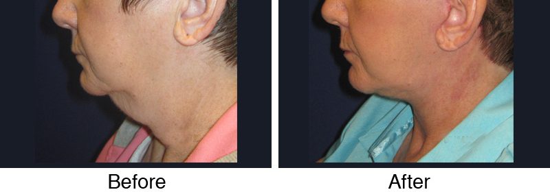 A man with an ear piercing and a chin implant.
