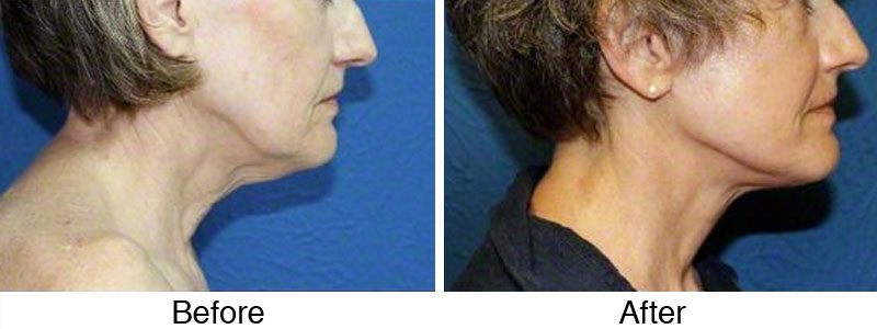 A woman with a facelift and chin implant