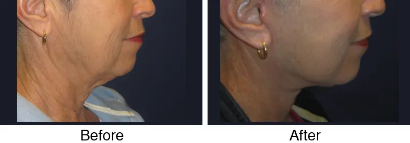 A woman with an earring is shown in two different photos.