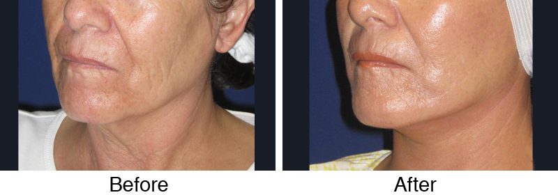 A before and after photo of an older woman 's face.