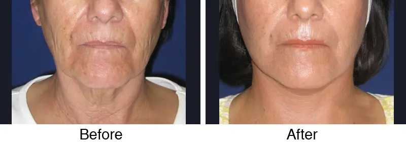 A woman with a facelift before and after