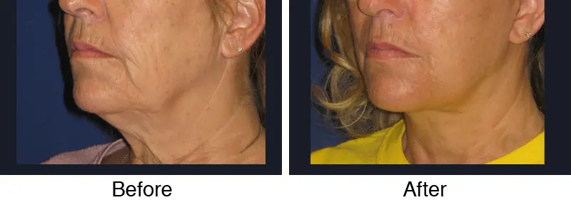 A woman with a facelift before and after