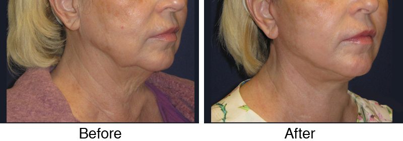 A woman with a facelift and neck lift