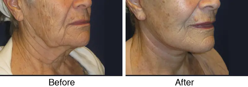 A before and after picture of an older woman 's face.