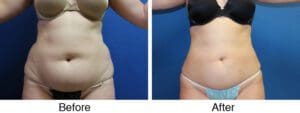 Before and after tummy contouring results