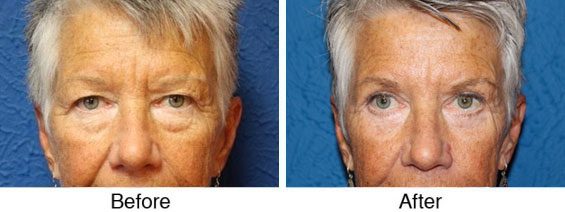 A before and after photo of an older woman 's eyes.