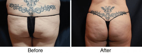 A before and after picture of the side view of an abdominoplasty.