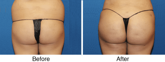 A before and after picture of the back of a woman 's buttocks.